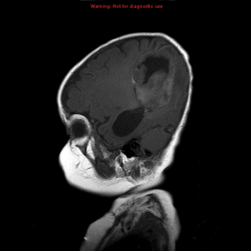 File:Atypical teratoid rhabdoid tumor (Radiopaedia 10712-11183 Sagittal T1 16).jpg