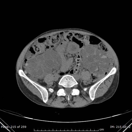File:Autosomal dominant polycystic kidney disease (Radiopaedia 44122-47684 Axial non-contrast 77).jpg
