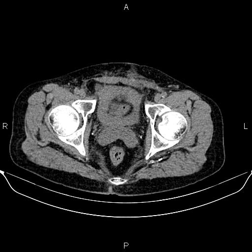 Autosomal dominant polycystic kidney disease (Radiopaedia 87830-104287 Axial non-contrast 53).jpg