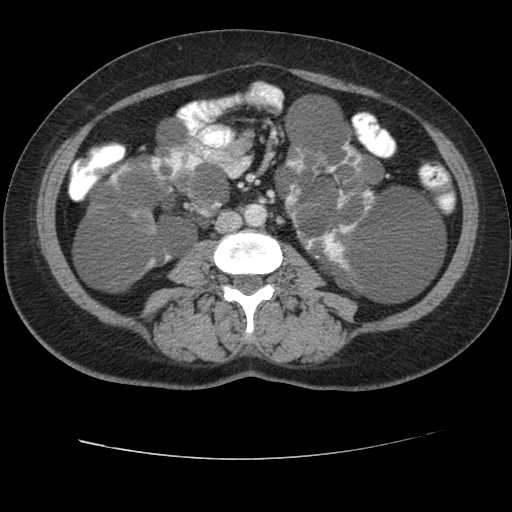 Autosomal dominant polycystic kidney disease with hepatic involvement (Radiopaedia 32693-33662 B 44).jpg