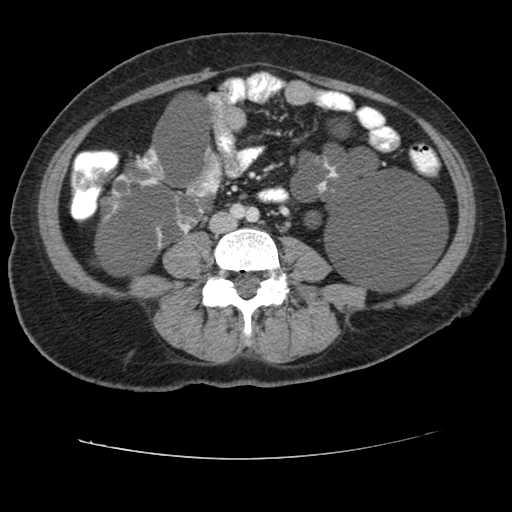 Autosomal dominant polycystic kidney disease with hepatic involvement (Radiopaedia 32693-33662 B 49).jpg