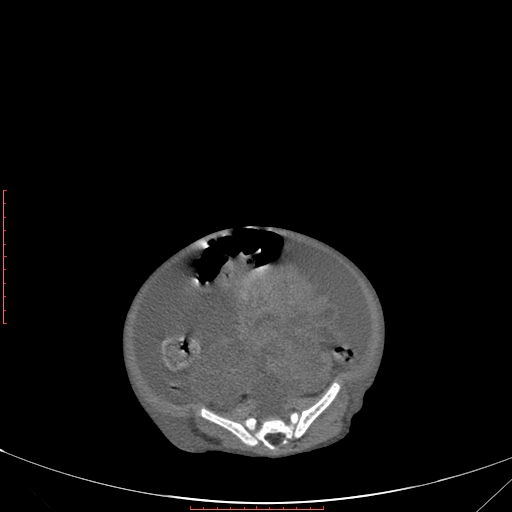 File:Autosomal recessive polycystic kidney disease associated with Caroli disease (Radiopaedia 61932-69984 B 285).jpg