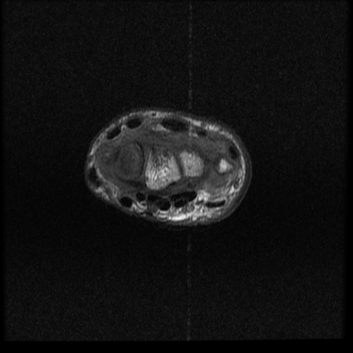 File:Avascular necrosis - scaphoid non-union (Radiopaedia 63457-72065 Axial T1 13).jpg