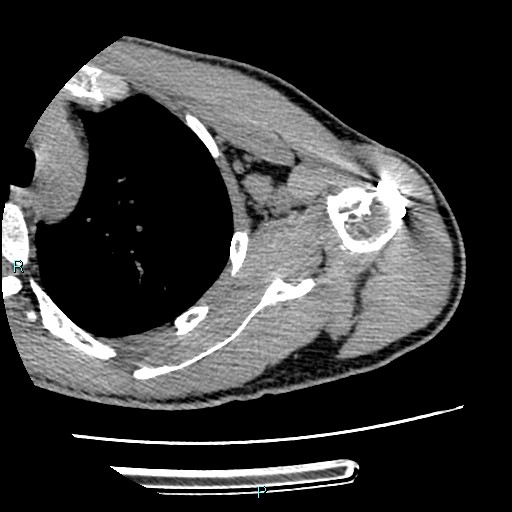 Avascular necrosis after fracture dislocations of the proximal humerus (Radiopaedia 88078-104655 D 60).jpg