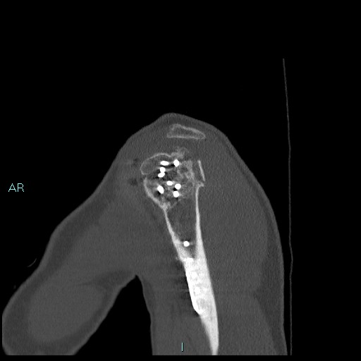 Avascular necrosis after fracture dislocations of the proximal humerus (Radiopaedia 88078-104655 Sagittal bone window 15).jpg