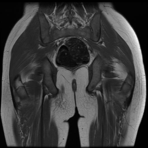 File:Avascular necrosis of the hip (Radiopaedia 29563-30067 Coronal T1 14).jpg