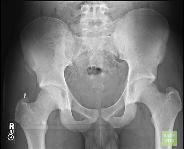 File:Avulsion fracture - anterior superior iliac spine (Radiopaedia 11227-11592 Frontal 1).jpg