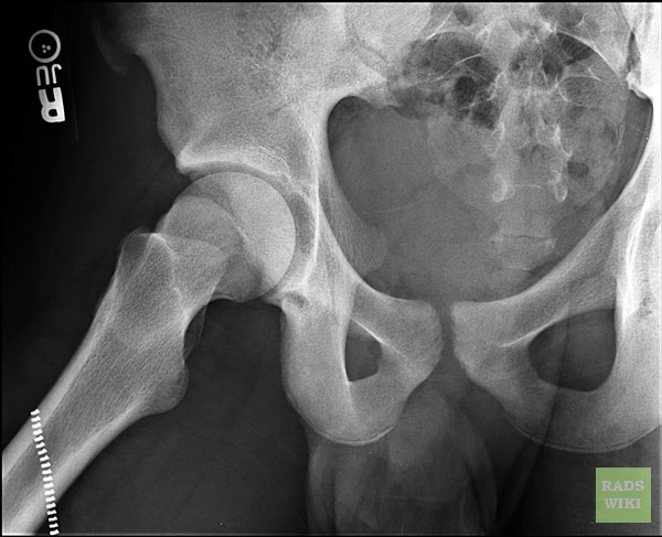File:Avulsion fracture - anterior superior iliac spine (Radiopaedia 11227-11592 Lateral 1).jpg