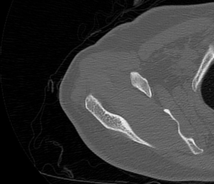Avulsion fracture - greater tuberosity of humerus (Radiopaedia 71216-81514 Axial bone window 20).jpg
