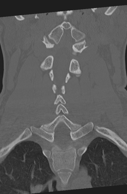 Axis peg fracture (type 3) and atlas lateral mass (type 4) fracture (Radiopaedia 37474-39324 Coronal bone window 27).png