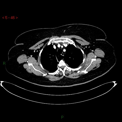 Azygos fissure and lobe (Radiopaedia 47620-52278 A 32).jpg