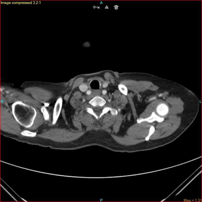 Azygos vein aneurysm (Radiopaedia 77824-90130 B 4).jpg