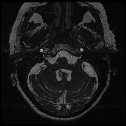 File:Balo concentric sclerosis (Radiopaedia 53875-59982 Axial T2 FIESTA 20).jpg