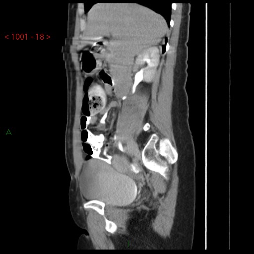 File:Bartholin gland cyst (Radiopaedia 54904-61181 Sagittal C+ delayed 18).jpg