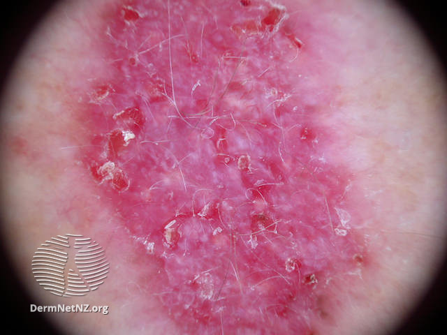 File:Basal cell carcinoma affecting the arms and legs 9 dermoscopy (DermNet NZ bcc-9-derm).jpg