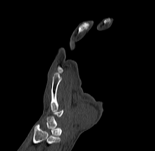Base of 2nd metacarpal fracture (Radiopaedia 73741-84544 Coronal bone window 30).jpg