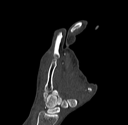 Base of 2nd metacarpal fracture (Radiopaedia 73741-84544 Coronal bone window 49).jpg