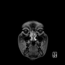 Base of skull rhabdomyosarcoma (Radiopaedia 32196-33142 I 14).jpg