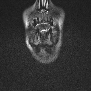 File:Base of tongue squamous cell carcinoma (Radiopaedia 31174-31884 Coronal T2 fat sat 26).jpg