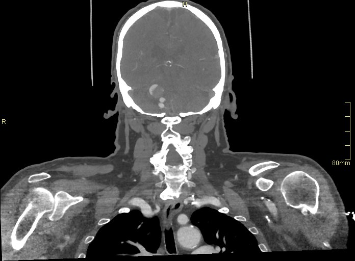 Basilar artery aneurysm (Radiopaedia 56261-62932 B 43).jpg