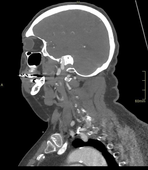 Basilar artery aneurysm (Radiopaedia 56261-62932 C 51).jpg