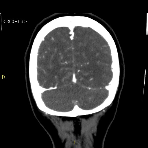 File:Basilar artery thrombosis (Radiopaedia 16260-15944 B 57).jpg