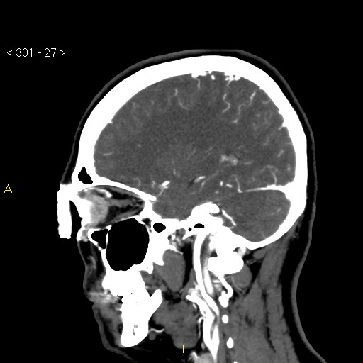 File:Basilar artery thrombosis (Radiopaedia 16260-15944 C 21).jpg