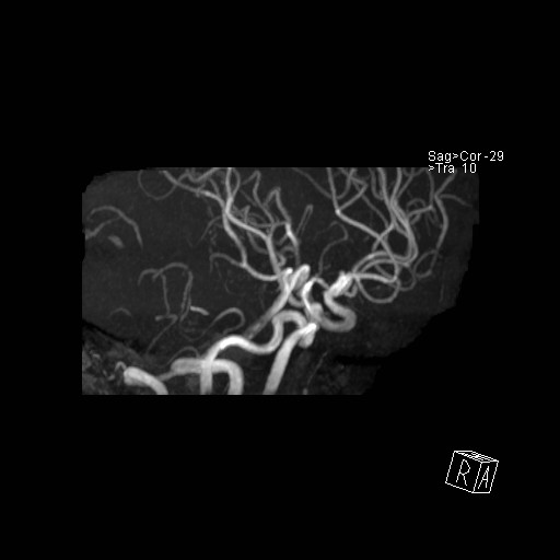 Basilar tip aneurysm (Radiopaedia 26504-26632 D 37).jpg