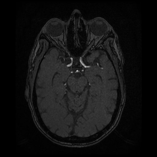 Basilar top and left middle cerebral artery aneurysm (Radiopaedia 61965-70031 Axial MRA 60).jpg