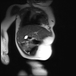 File:Beckwith-Wiedeman syndrome with bilateral Wilms tumors (Radiopaedia 60850-69233 B 23).jpg