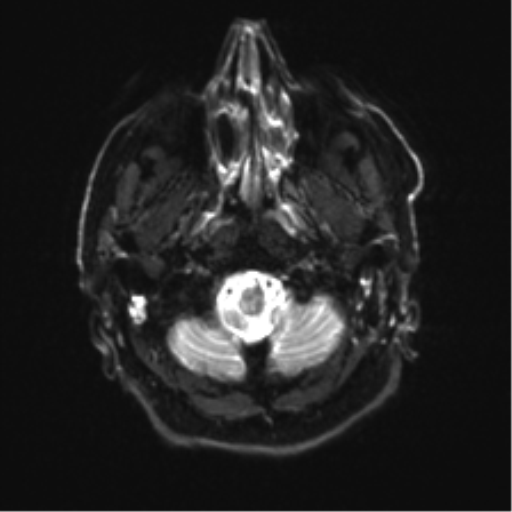 File:Behavioral variant frontotemporal dementia and late onset schizophrenia (Radiopaedia 52197-58083 Axial DTI Trace W 3).png