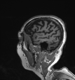 Behavioral variant frontotemporal dementia and late onset schizophrenia (Radiopaedia 52197-58083 Sagittal T1 2).png