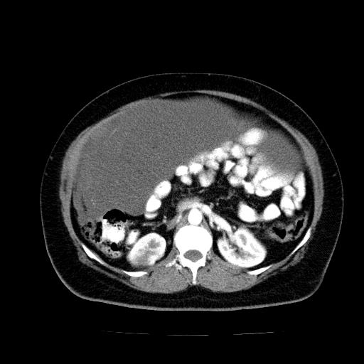 Benign spindle cell tumor - abdominopelvic (Radiopaedia 61300-69212 A 25).jpg