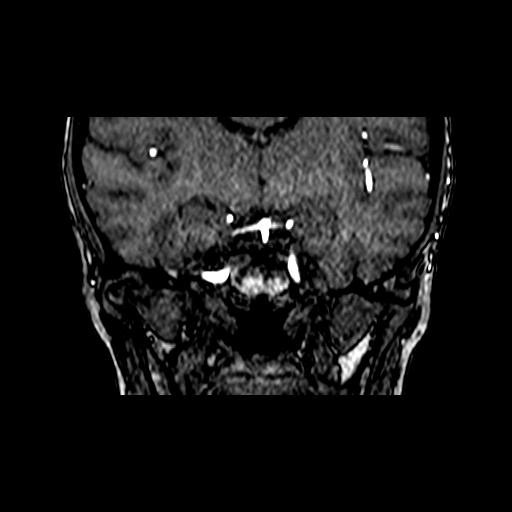 Berry aneurysm of the terminal internal carotid artery (Radiopaedia 88286-104918 Coronal TOF 47).jpg