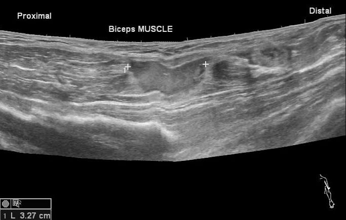 File:Biceps muscle tear (Radiopaedia 29209-29603 E 1).jpg