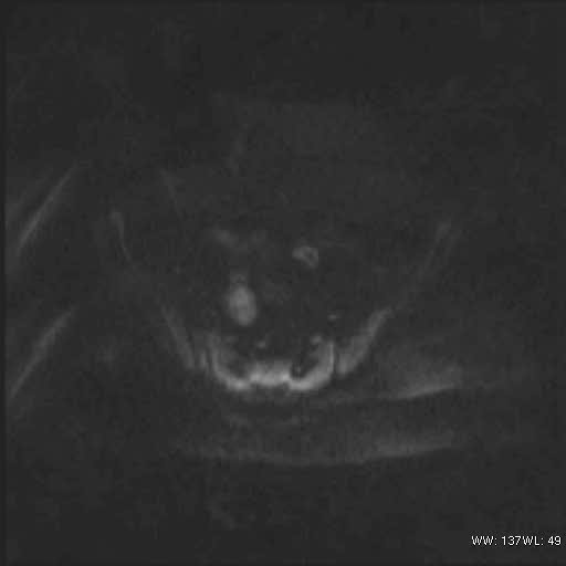 File:Bicornuate uterus (MRI) (Radiopaedia 49206-54297 Axial 106).jpg