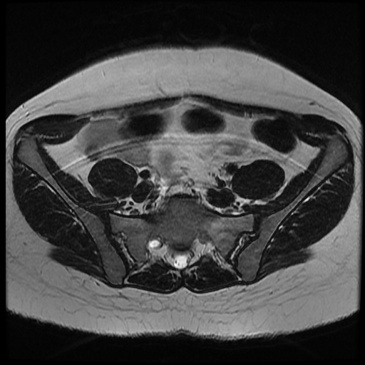 File:Bicornuate uterus (Radiopaedia 51676-57472 Axial T2 28).jpg