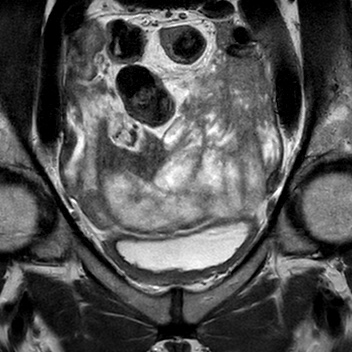 File:Bicornuate uterus (Radiopaedia 61974-70046 Coronal T2 3).jpg