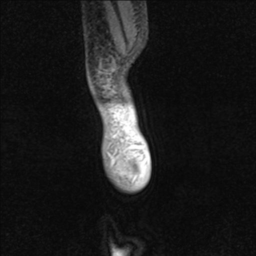 File:Bilateral Achilles tendon complete tear (Radiopaedia 81344-95051 Sagittal WE - Left 106).jpg