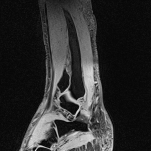 Bilateral Achilles tendon complete tear (Radiopaedia 81344-95051 Sagittal WE - Left 86).jpg