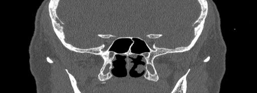 Bilateral Ectopic Infraorbital Nerves (Radiopaedia 49006-54084 Coronal bone window 66).jpg