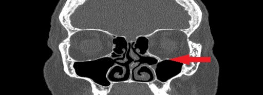 File:Bilateral Ectopic Infraorbital Nerves (Radiopaedia 49006-58325 Coronal 8).jpg
