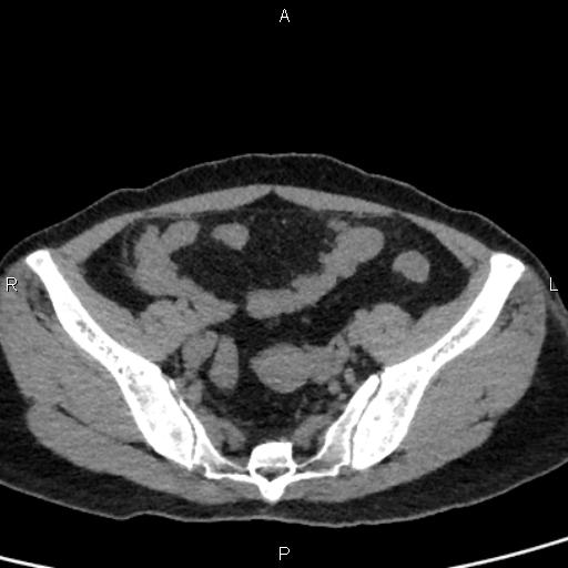 Bilateral adrenal gland hyperenhancement in pancreatitis (Radiopaedia 86642-102753 Axial non-contrast 90).jpg