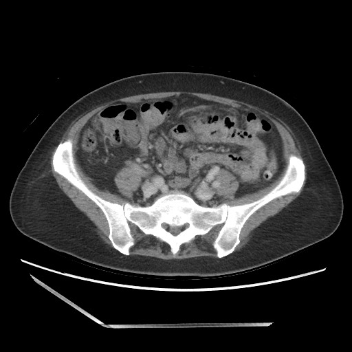Bilateral adrenal granulocytic sarcomas (chloromas) (Radiopaedia 78375-91007 A 81).jpg