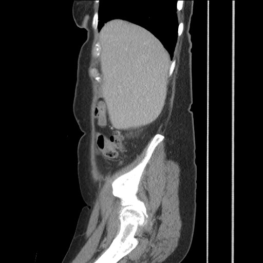 File:Bilateral adrenal granulocytic sarcomas (chloromas) (Radiopaedia 78375-91007 C 36).jpg