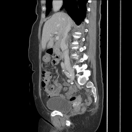 Bilateral adrenal granulocytic sarcomas (chloromas) (Radiopaedia 78375-91007 C 63).jpg