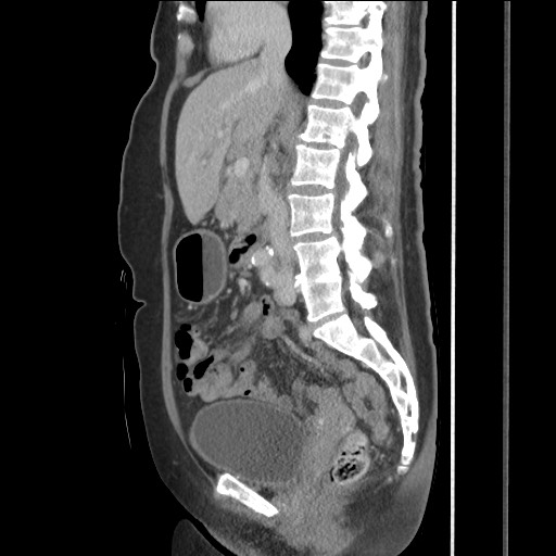 Bilateral adrenal granulocytic sarcomas (chloromas) (Radiopaedia 78375-91007 C 69).jpg