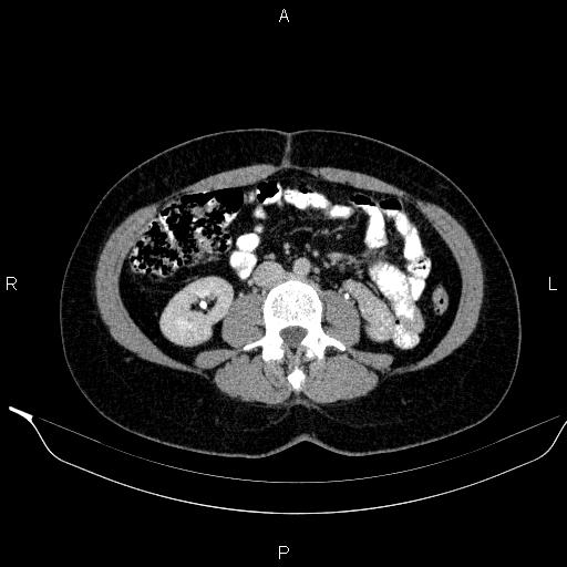 Bilateral adrenal myelolipoma (Radiopaedia 63058-71535 Axial C+ delayed 74).jpg