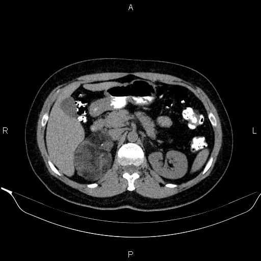 Bilateral adrenal myelolipoma (Radiopaedia 63058-71535 Axial non-contrast 57).jpg