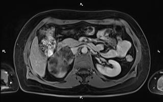File:Bilateral adrenal myelolipoma (Radiopaedia 63058-71537 H 44).jpg